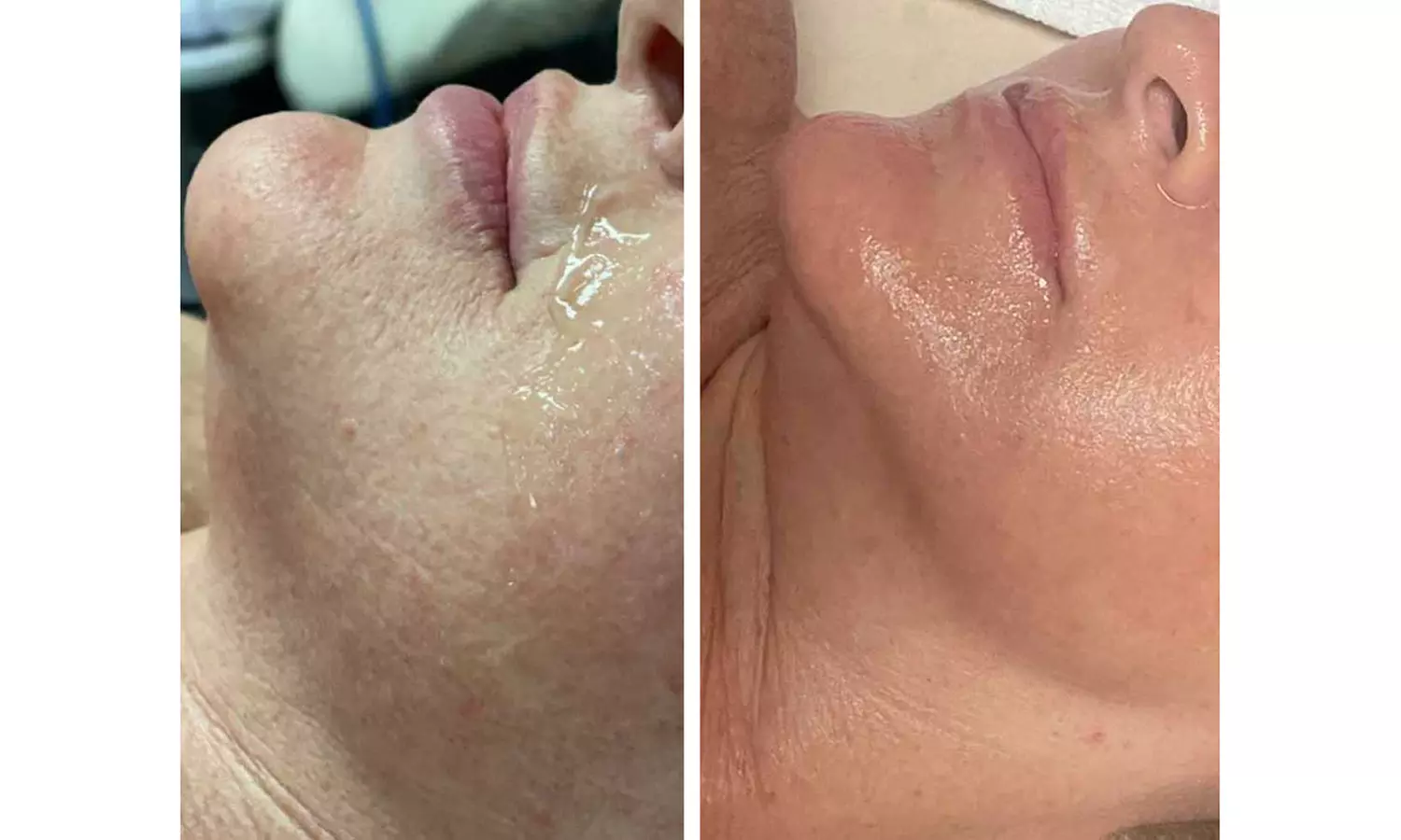 One, Two, or Three 60-Minutes Belle Hydra Rejuvenation Sessions