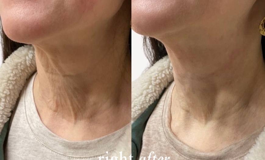 Image 5: Up to 33% Off on Injectables at Hush Aesthetics, LLC