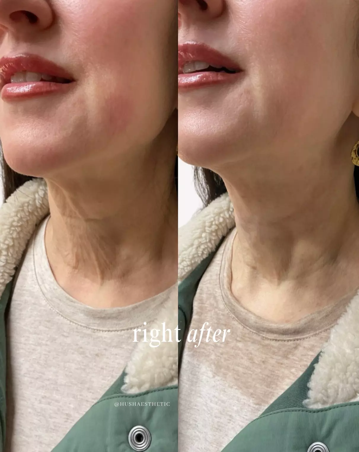 Up to 45% Off on Injectables at Hush Aesthetics, LLC