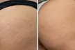 Restore with Stretch Mark Camouflage or Scar Revision/Camouflage at  Invisible Ink Skin Solutions(Up to 40%
Off) - Second Medium