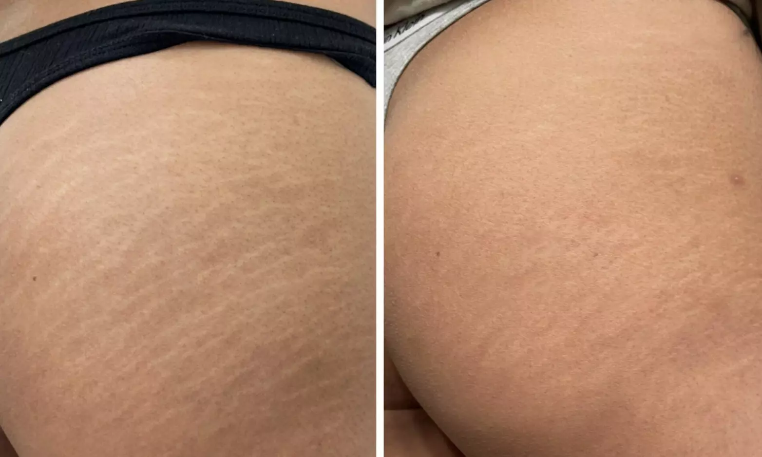 Transform with Stretch Mark Camouflage or Scar Revision/Camouflage