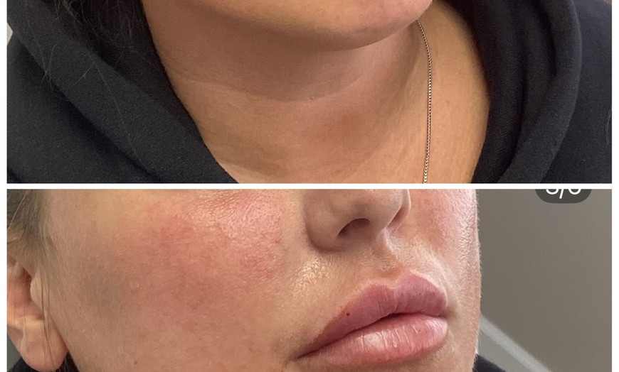 Image 4: Refresh with One Syringe of RHA 2, RHA 3, or Revanesse Versa