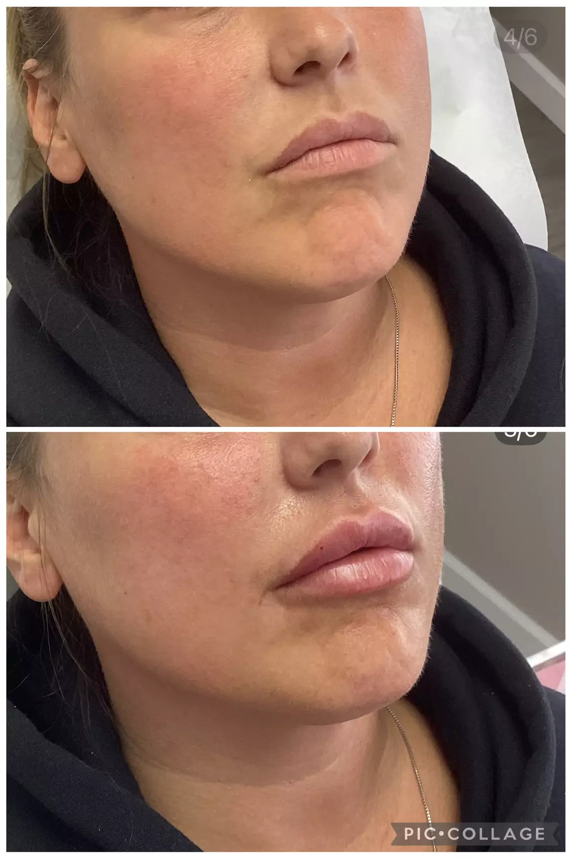 Refresh with One Syringe of RHA 2, RHA 3, or Revanesse Versa