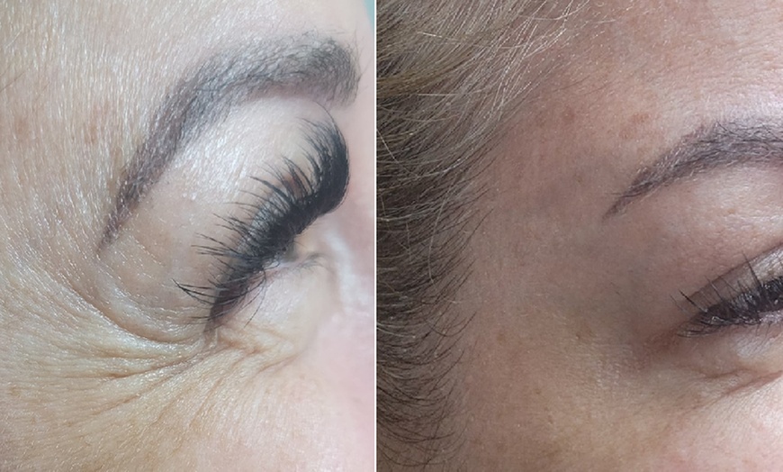 Image 5: Get Refreshed with 20, or 40 Units of Xeomin Injections 