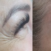 Image 5: Get Refreshed with 20, or 40 Units of Xeomin Injections 