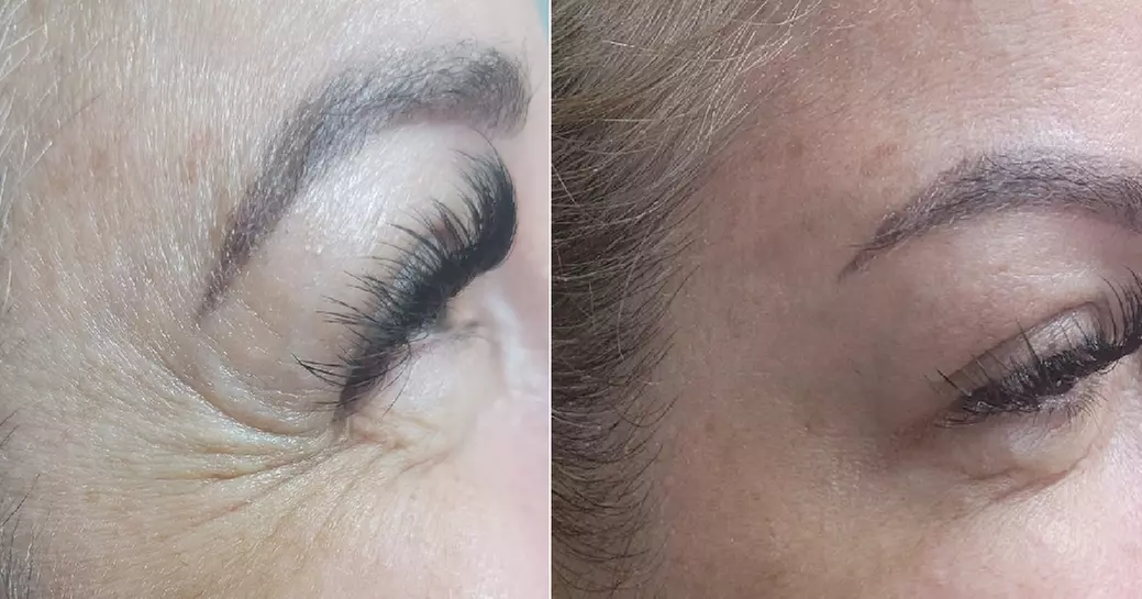Get Refreshed with 20, or 40 Units of Xeomin Injections