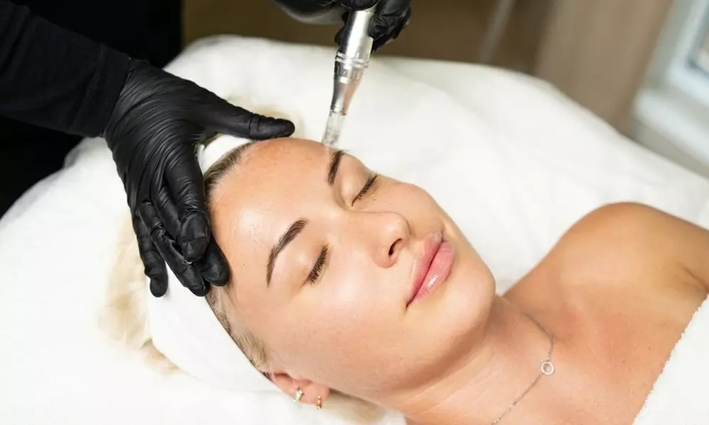 Get Smoother Skin with One, Two, or Three Micro-needling Sessions