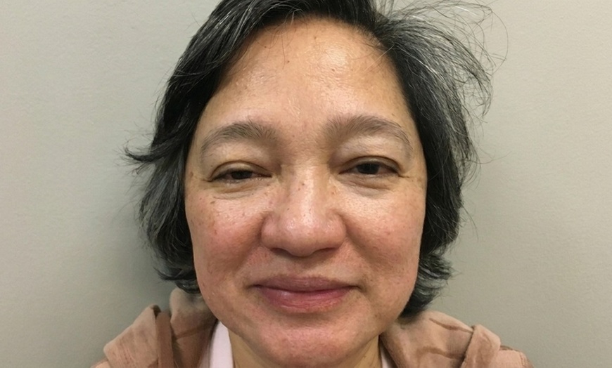 Image 3: 1, 3, or 5 Fractional Laser Skin Resurfacing Sessions for Full Face