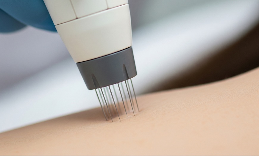 Image 3: Classic Eyelash Extensions or Skin Needling Face Treatment For One 