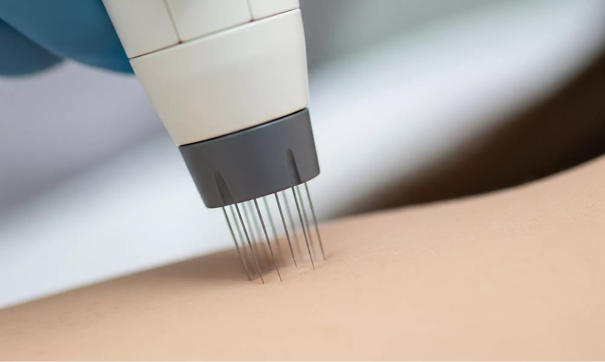 Classic Eyelash Extensions or Skin Needling Face Treatment For One