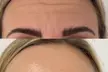 Reveal a Relaxed Look with 20, 40, or 60 Botox Units (Up to 44% Off) - Second Medium