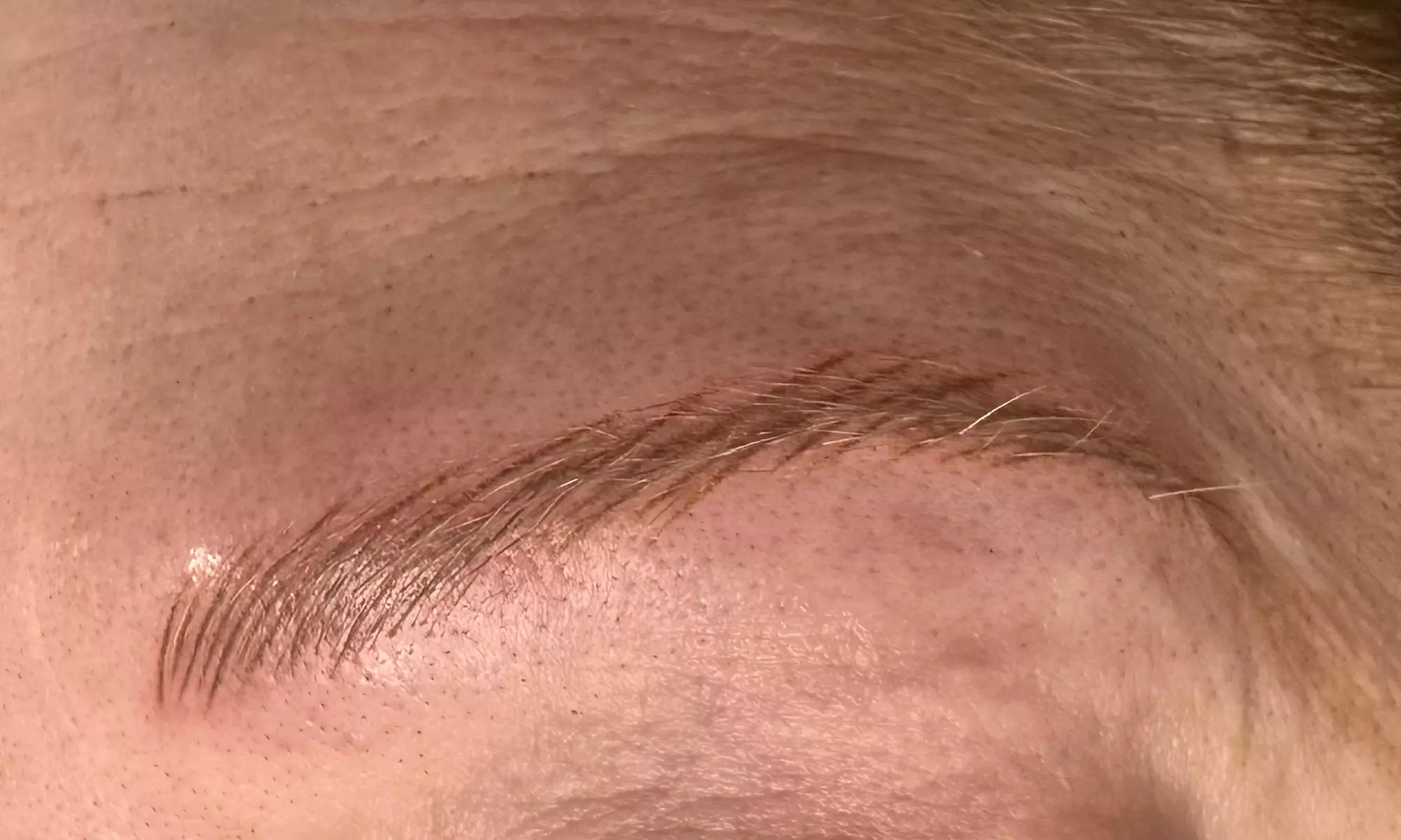 Nano Hair Stroke Brows, Microblading, or Skin Lesion or Mole Removal