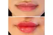 Enhance Beauty with One or Half Syringe of Dermal Filler at Aura Medical Spa (Up to 40% Off) - Second Medium