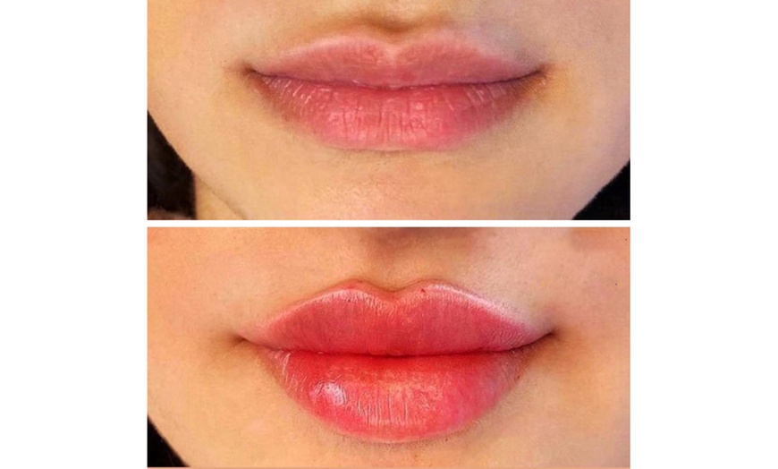 Image 2: Enhance Beauty with One or Half Syringe of Dermal Filler