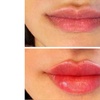 Image 2: Enhance Beauty with One or Half Syringe of Dermal Filler