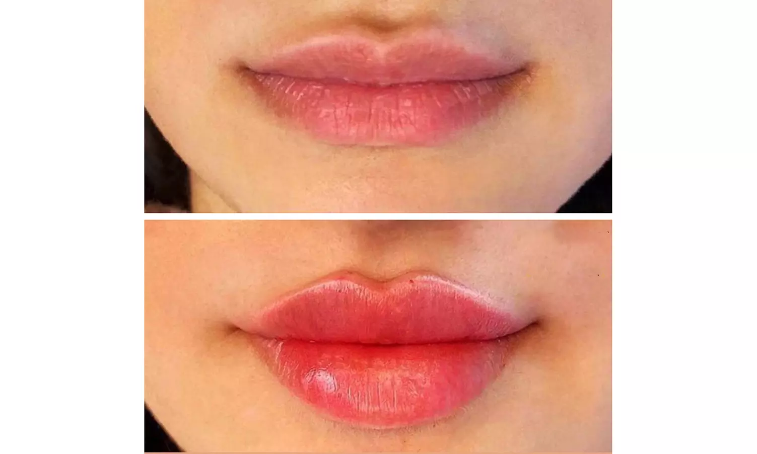 Enhance Beauty with One or Half Syringe of Dermal Filler