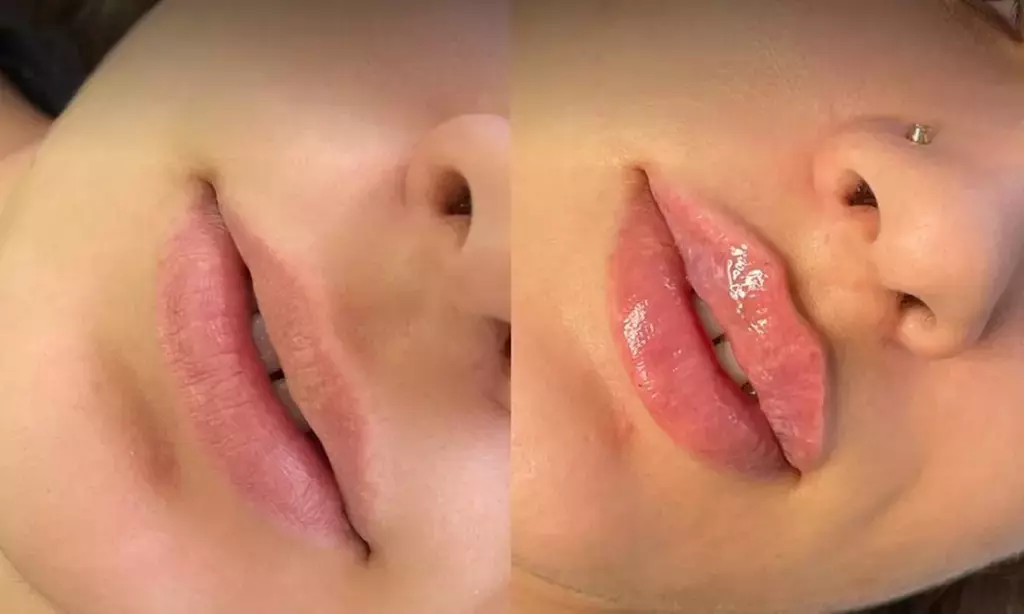 Rejuvenate with One Half or Full Syringe of Revanesse Versa