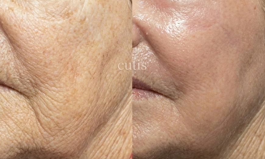 Image 6: Boost Collagen with 2 CC, 3 CC, 4 CC, or 5 CC of Sculptra Injections