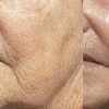 Image 6: Boost Collagen with 2 CC, 3 CC, 4 CC, or 5 CC of Sculptra Injections