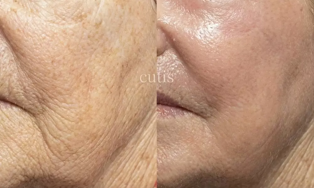 Boost Collagen with 2 CC, 3 CC, 4 CC, or 5 CC of Sculptra Injections