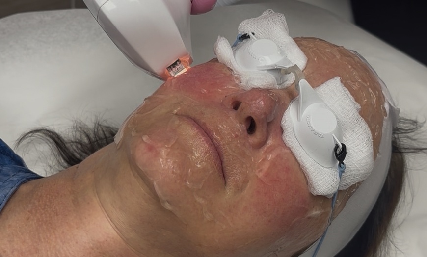 Image 3: Get Smooth Skin with IPL Lumecca Photo Facial Options