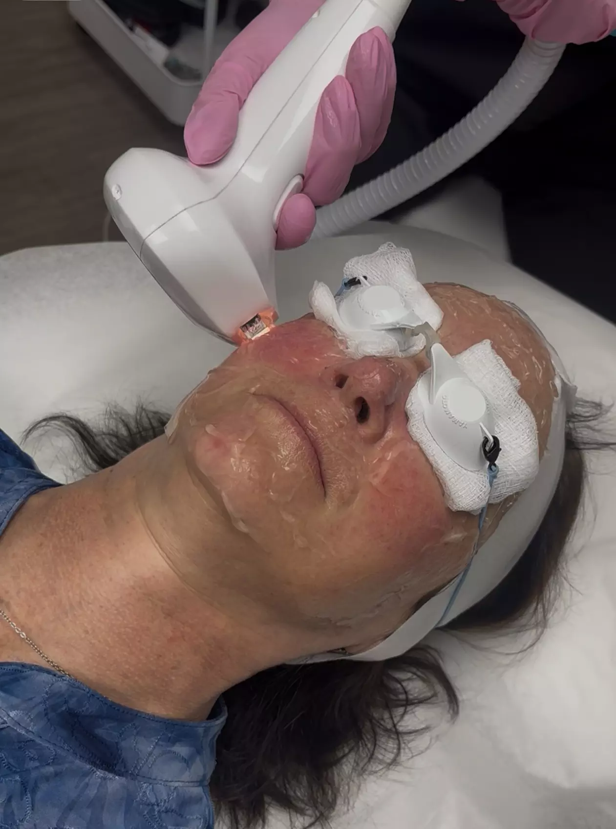 Get Smooth Skin with IPL Lumecca Photo Facial Options