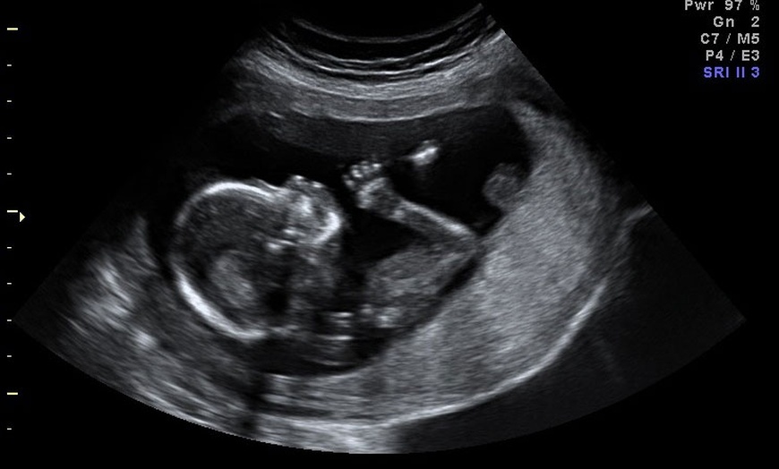 Image 6: 3D/ 4D Baby Scan