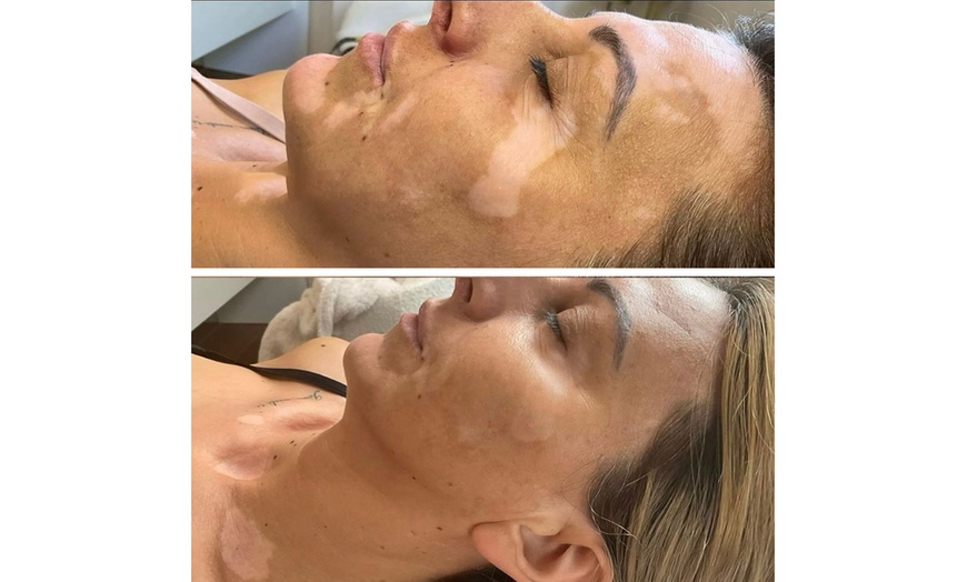 Image 2: Skin Camouflage for Scars, Stretch Marks & Vitiligo (1–3 Sessions)
