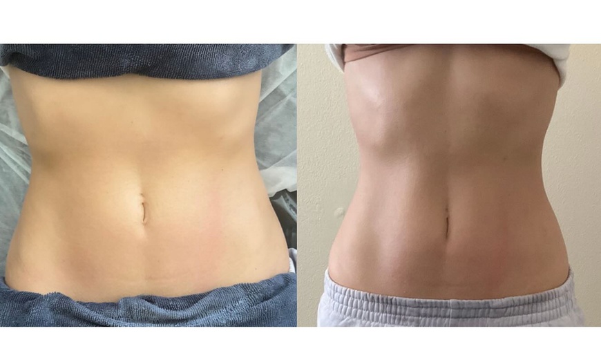 Image 4: 45 or 60-Minute Post-Op Massages for Optimized Surgical Recovery