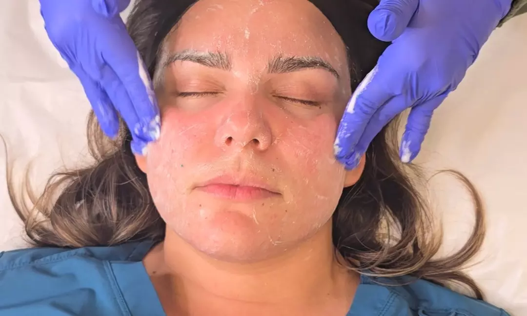 Experience Radiance: One or Three Light or Deep Chemical Peels