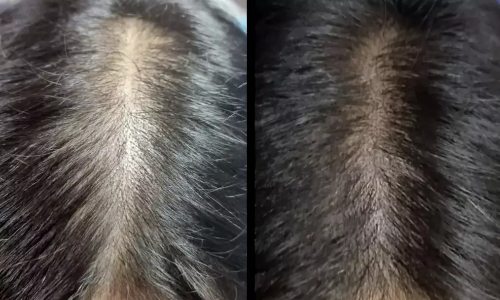 Scalp Micropigmentation Hair Loss, Balding, or Thinning Treatment