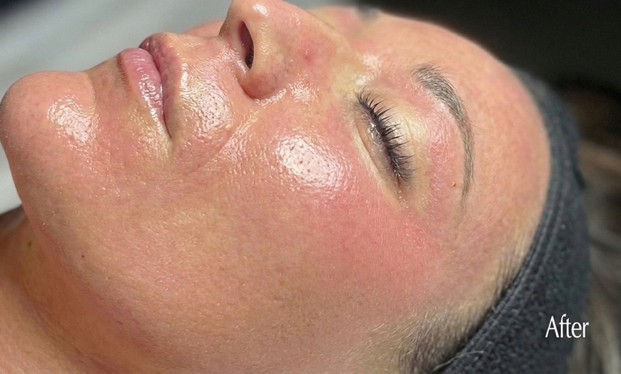 Image 3: 1, 2, or 3 Facials or Upgrade to Dermaplaning/Microdermabrasion
