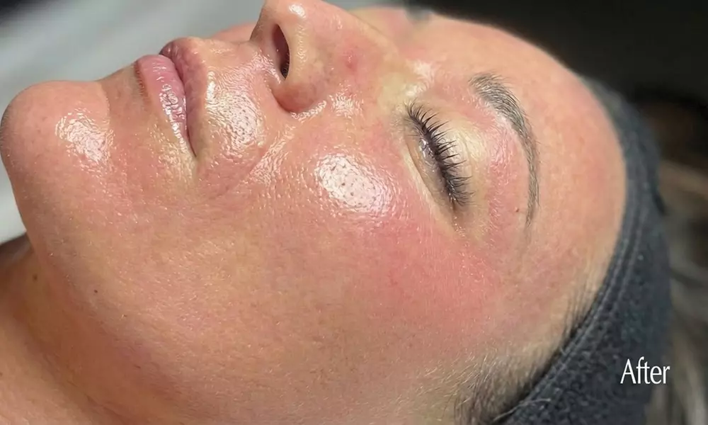 1, 2, or 3 Facials or Upgrade to Dermaplaning/Microdermabrasion