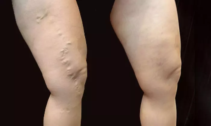Up to 87% Off on Spider Vein Removal - Injection at Charming Skin Vein Center