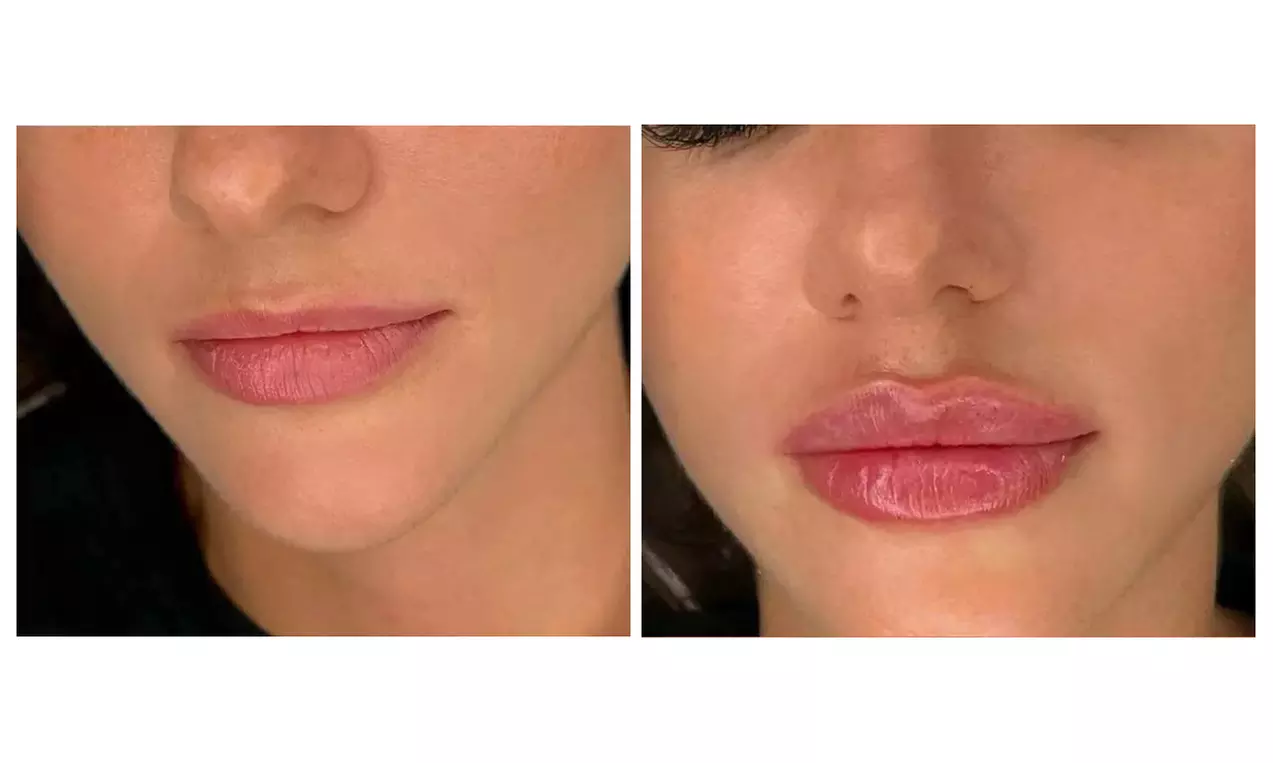 Enhance Your Look with One Half or Full Syringe of Revanesse Versa @Nectar Aesthetics & Wellness (Up to 44%
Off) - Primary Image