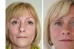 2CC, 1 Vial or 4 Vials of Sculptra Aesthetic at Age Well Dr Labs, Up to 50% Off  - Second Medium