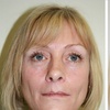 Image 3: Up to 57% Off on Injection Sculptra at Age Well Dr Labs