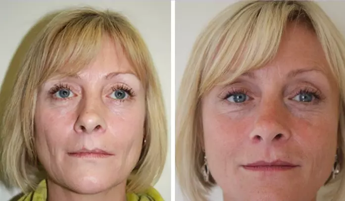 Sculptra Aesthetic Injections for a Youthful Glow