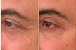 Transform Your Look with 30 or 60 Units of Dysport at Youthful Glow ( Up to 51% Off ) - Second Medium