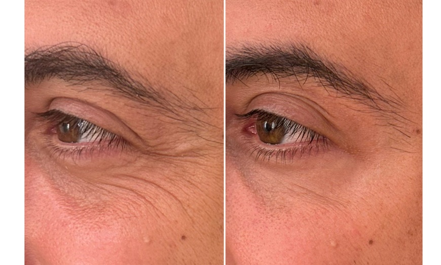Image 6: Revitalize with 30 or 60 Units of Dysport at Youthful Glow