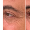 Image 6: Revitalize with 30 or 60 Units of Dysport at Youthful Glow