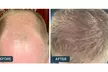 Receive A Free Dermatologist Consultation with Big Savings on Rx Hair Growth Solutions At Happy Head (Up to 60% Off) - Second Medium