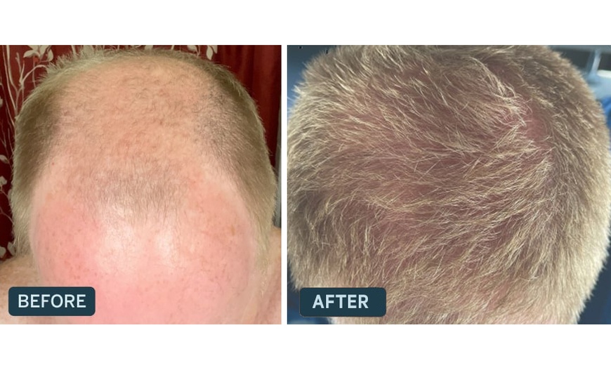 Image 3: Receive A Free Dermatologist Consultation with Big Savings on Rx Hair Growth Solutions At Happy Head