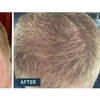 Image 4: Big Savings on Customized Rx Hair Growth Solutions and Receive A Free Dermatologist Consultation at Happy Head