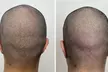 2 or 4 Hour Scalp Micropigmentation for Hairline, Crown or Full Scalp Restoration at Authentic SMP(Up to 33%Off) - Second Medium