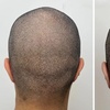 Image 5: 1 or 2 2Hour Scalp Micropigmentation for Hairline & Crown Restoration