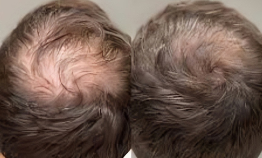 Image 2: Bioestimulación facial o capilar con opción a vitaminas o peeling 