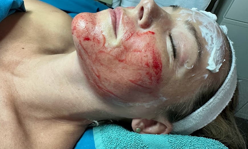 Image 2: Experience rejuvenation with PRP facial treatments