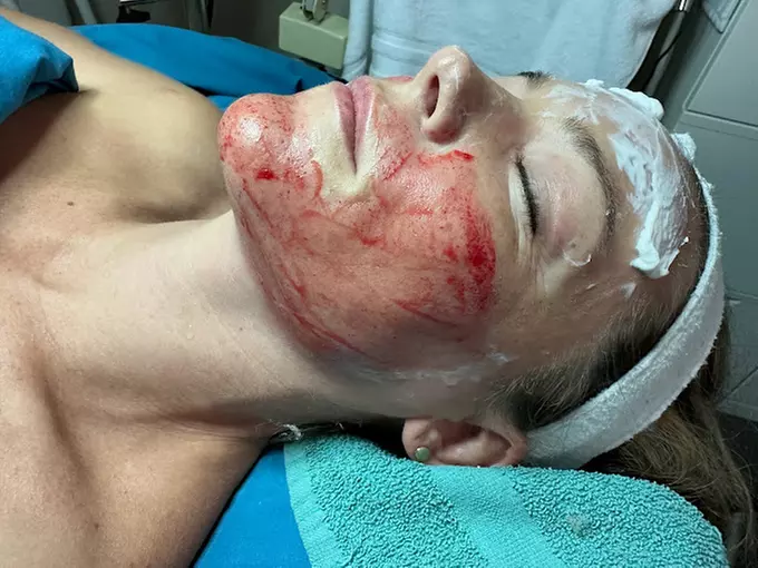 Experience rejuvenation with PRP facial treatments