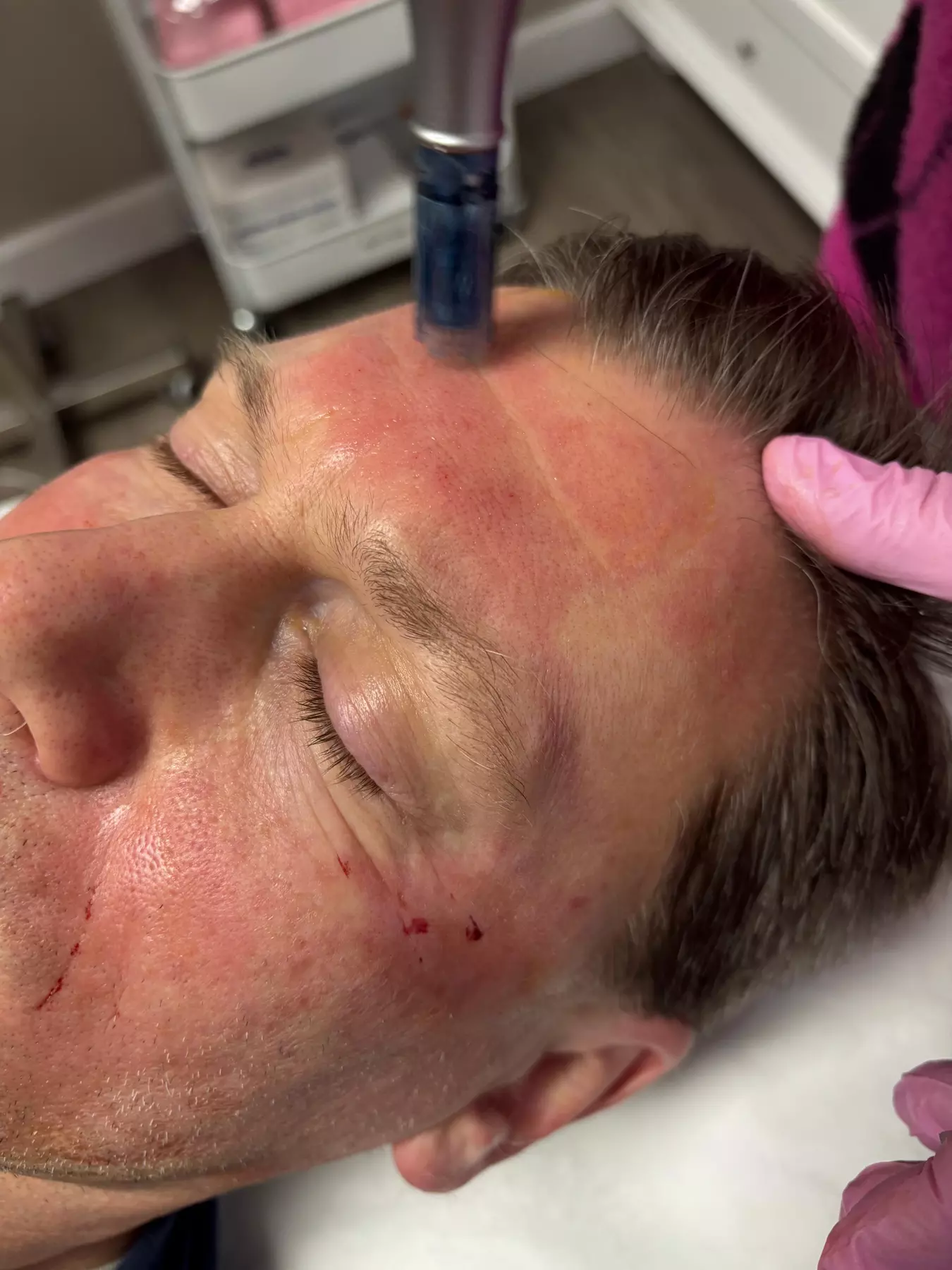 Rejuvenate Your Skin with Microneedling Options